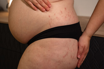 Pregnant woman at 9 months of pregnancy showing stretch marks on belly and leg close up. Body positive. Anticipation getting ready for the maternity