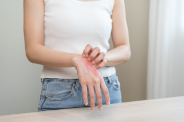 Dermatology asian young woman allergy, allergic reaction from atopic, insect bite, scratching itchy...