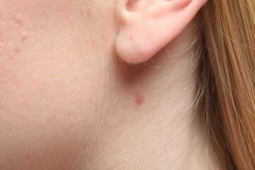 Woman with mole on her neck, closeup