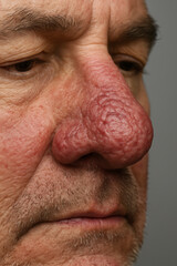Senior man showing symptoms of rhinophyma on his nose