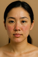 Young woman showing symptoms of rosacea on face