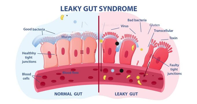 Leaky gut Syndrome. Comparison of healthy organ and inflamed tissue cells. Diseases of gastrointestinal tract. Moving banner with medical infographics. Flat graphic animated cartoon