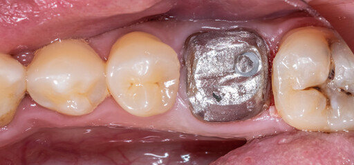 Mandibular arch with decayed molar crown destroyed and restored with metallic post and core...