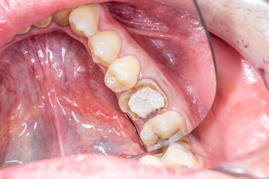 Directly above mirror view of a mandibular arch part with decayed molar crown completely destroyed and damaged with remaining structure sealed with a temporary white cement to protect the root canals - Powered by Adobe