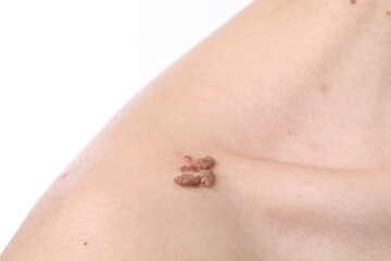 Obraz premium Woman with moles on her body against white background, closeup