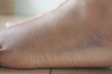 Fototapeta premium close up of women feet with swelling