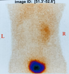 DTPA Renogram report. Right kidney is normal, but left kidney cortical uptake phase and excretory...