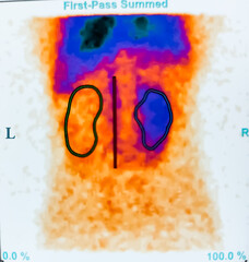 DTPA Renogram report. Right kidney is normal, but left kidney cortical uptake phase and excretory...