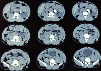 CT scan of KUB (non-contrast): Large calculus at left pelvi-ureteric junction(PUJ) with left sided...