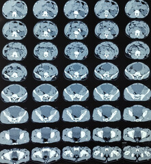 CT scan of KUB (non-contrast): Large calculus at left pelvi-ureteric junction(PUJ) with left sided...