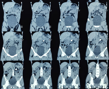 CT scan of KUB (non-contrast): Large calculus at left pelvi-ureteric junction(PUJ) with left sided gross hydro-ureteronephrosis. Kidney stone.