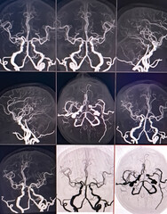 MRI of brain and MRA. CT Angiogram Brain showing anterior communicatting artery small dilatation, saccular aneurism. Hypoplasia of A1 segment. Cerebral atrophy.