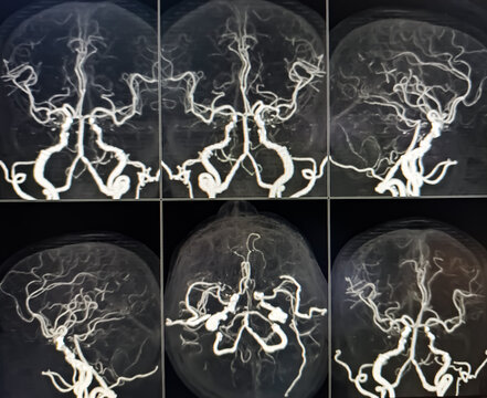 MRI of brain and MRA. CT Angiogram Brain showing anterior communicatting artery small dilatation, saccular aneurism. Hypoplasia of A1 segment. Cerebral atrophy.