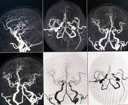 MRI of brain and MRA. CT Angiogram Brain showing anterior communicatting artery small dilatation, saccular aneurism. Hypoplasia of A1 segment. Cerebral atrophy.