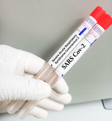 Nasal swab sample for SARS CoV-2 Omicron subvariant LF.7, XFG, JN-1, NB 1.8.1 'Centaurus' virus mutation test at medical laboratory.