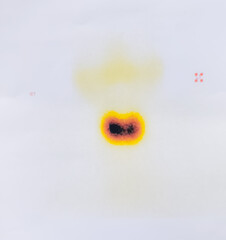 Scintigraphy of thyroid gland with nodule, it's the the medical examination result. Thyromegaly, toxic goitre.