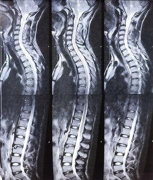 MRI scan of lambo-sacaral spine (LS-spine) : Central and left paracentral extrusion. Nerve root compression with spinal canal stenosis. Fracture of Lumber spine. Medical image concept.