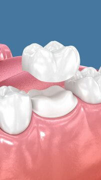 Preparated molar tooth and dental crown placement. Dental 3D animation