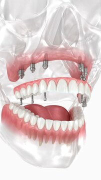 Dental prosthesis based on six implants. Dental 3D animation