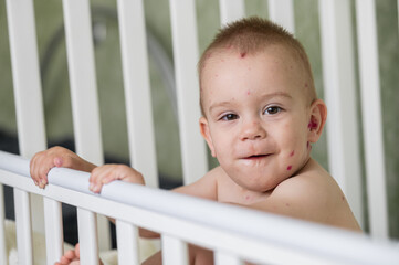 Toddler with Chickenpox Sitting in Bed