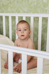 Toddler with Chickenpox Sitting in Bed