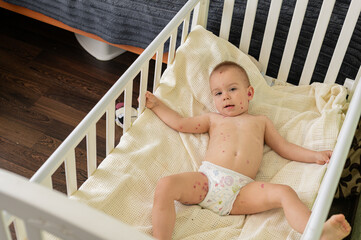Toddler with Chickenpox Sitting in Bed