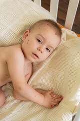 Toddler with Chickenpox Sitting in Bed