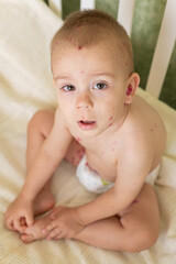 Toddler with Chickenpox Sitting in Bed