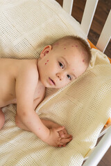 Toddler with Chickenpox Sitting in Bed