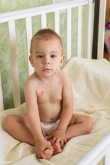 Toddler with Chickenpox Sitting in Bed