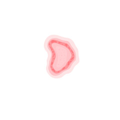 Dermatophytosis illustration