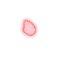 Dermatophytosis illustration