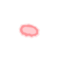 Dermatophytosis illustration