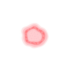 Dermatophytosis illustration