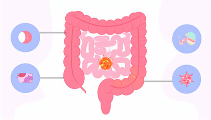 Colon Cancer Illustration Diagram.