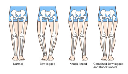正常な脚、O脚、X脚、XO脚の姿勢と骨格