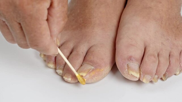 toenail infection ringworm, nail fungus care and treatment.