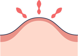 Illustration of skin layers with a swollen lump. The raised area and red marks symbolize inflammation, pain, and edema, representing a medical condition or injury.