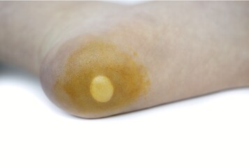 Close-Up of a Callus or Corn on a Human Heel