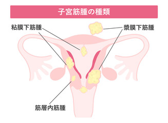 子宮筋腫の種類
