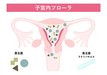 子宮内フローラ
