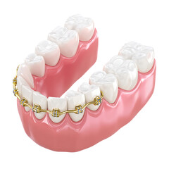 Gold and metal dental braces on teeth.