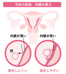 不妊の原因_内膜の厚さ