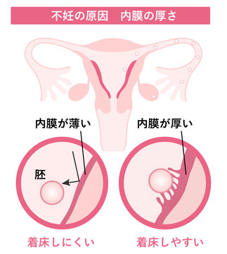 不妊の原因_内膜の厚さ