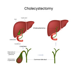 Cholecystectomy Surgical Removal of Gallbladder