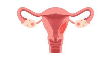 Illustration of Damaged Uterus for Awareness on Women's Health Issues and Gynecological Diseases