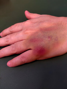Close-up of a hospital patient's hand showing prominent bruising, likely from an injection or intravenous procedure, on a dark background. Medical concept
