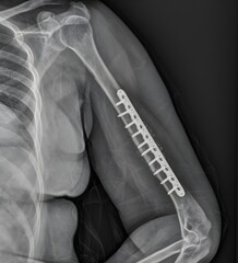 image results from an x-ray examination of a broken arm with an implant