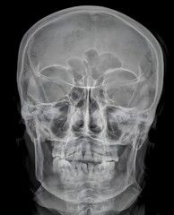 image results from an x-ray examination of the facial bones