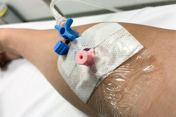 Close up view of a patient’s arm with a pink intravenous (IV) cannula and blue three way stopcock...